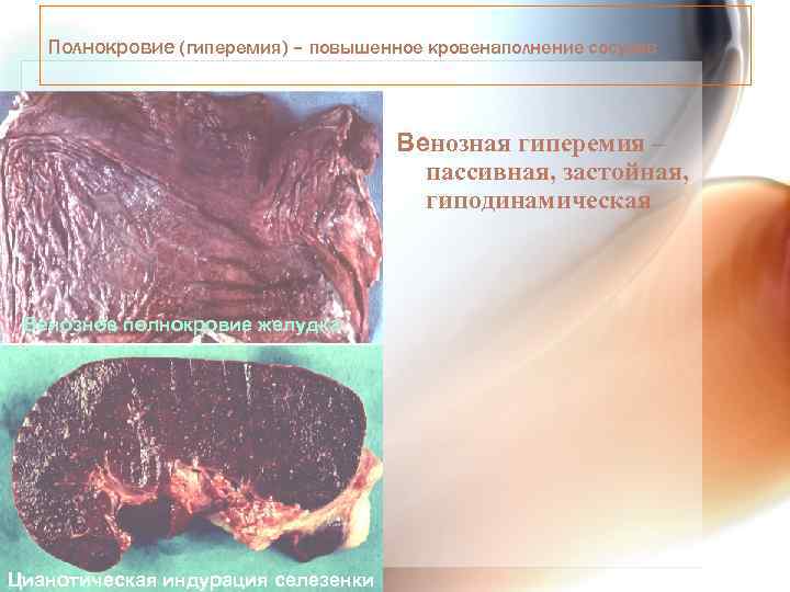 Полнокровие (гиперемия) – повышенное кровенаполнение сосудов Венозная гиперемия – пассивная, застойная, гиподинамическая Венозное полнокровие