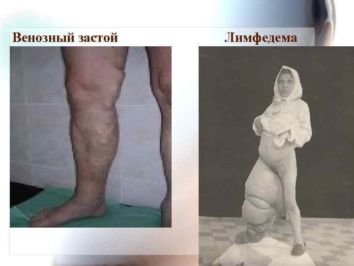 Венозный застой Лимфедема 