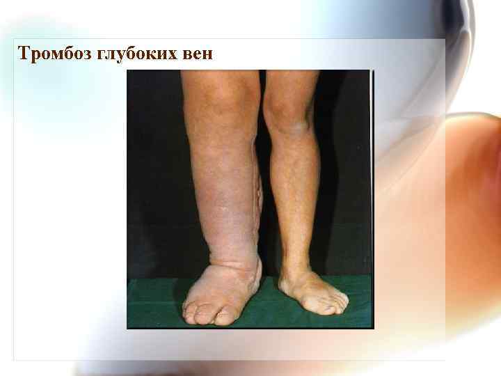 Тромбоз глубоких вен 