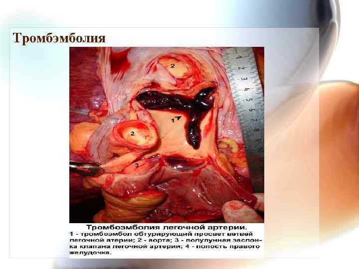 Тромбэмболия 