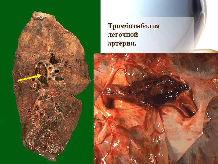 Тромбоэмболия легочной артерии. 