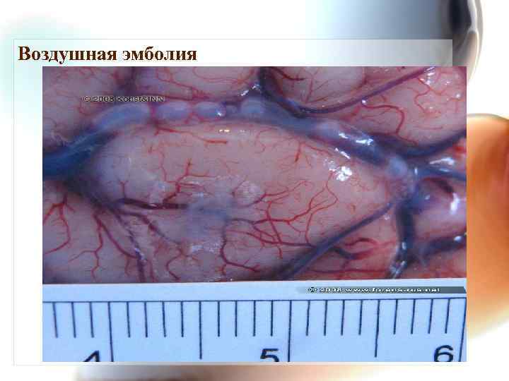 Воздушная эмболия 