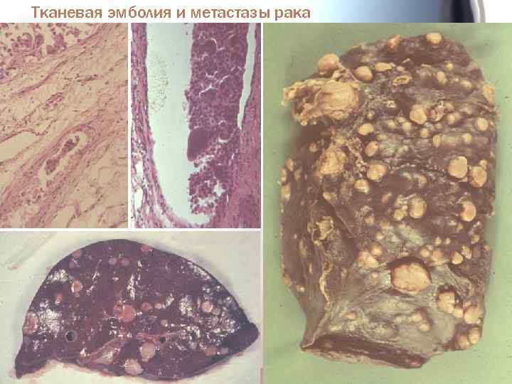 Тканевая эмболия и метастазы рака 
