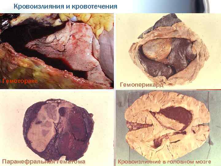 Кровоизлияния и кровотечения Гемоторакс Паранефральная гематома Гемоперикард Кровоизлияние в головном мозге 