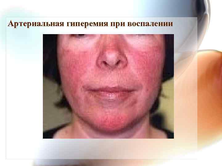 Артериальная гиперемия при воспалении 
