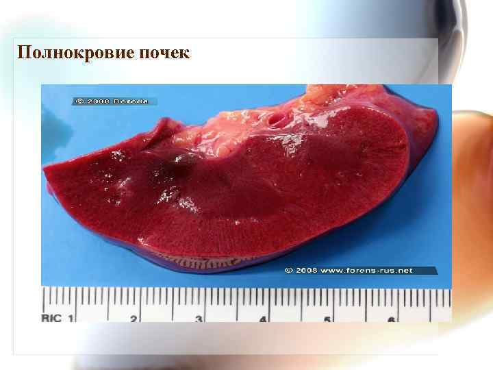 Полнокровие почек 