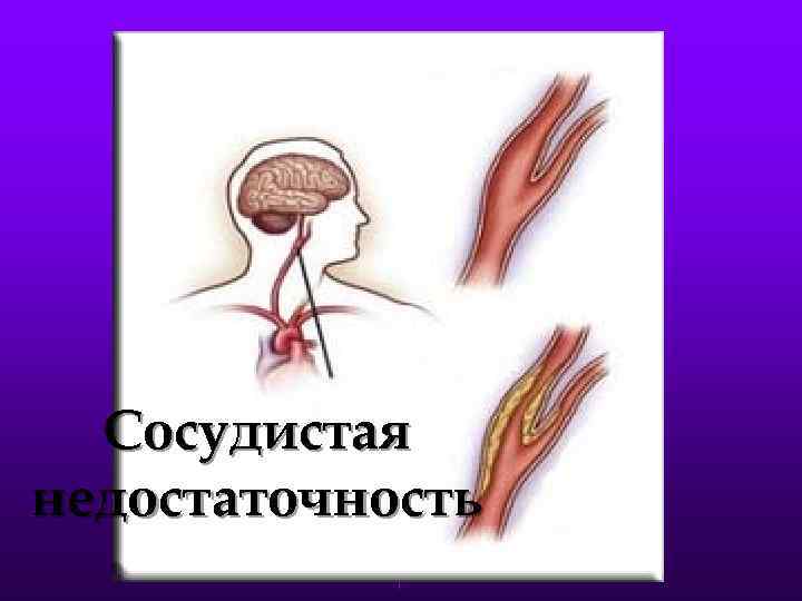 Сосудистая недостаточность 