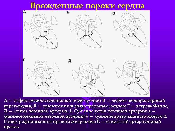 Врожденные пороки сердца А — дефект межжелудочковой перегородки; Б — дефект межпредсердной перегородки; В