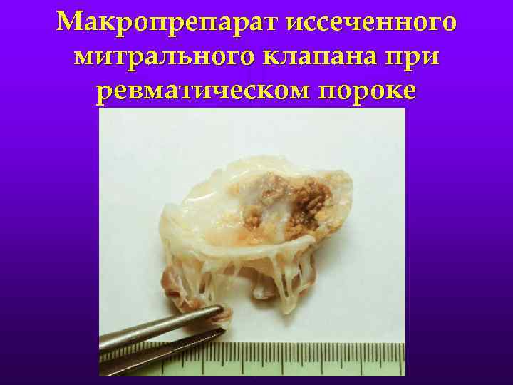 Макропрепарат иссеченного митрального клапана при ревматическом пороке 