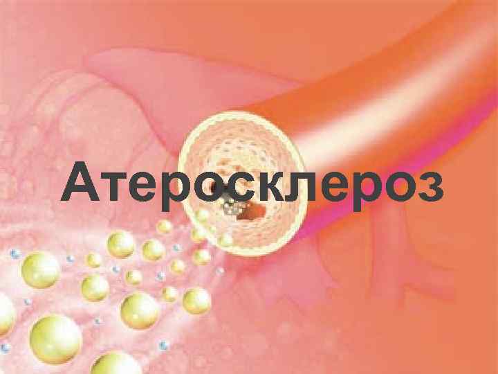 Атеросклероз 