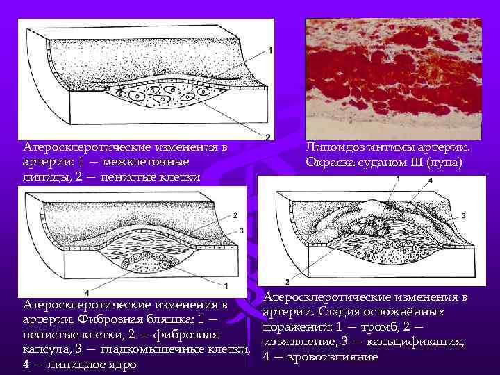Атеросклеротические изменения в артерии: 1 — межклеточные липиды, 2 — пенистые клетки Атеросклеротические изменения