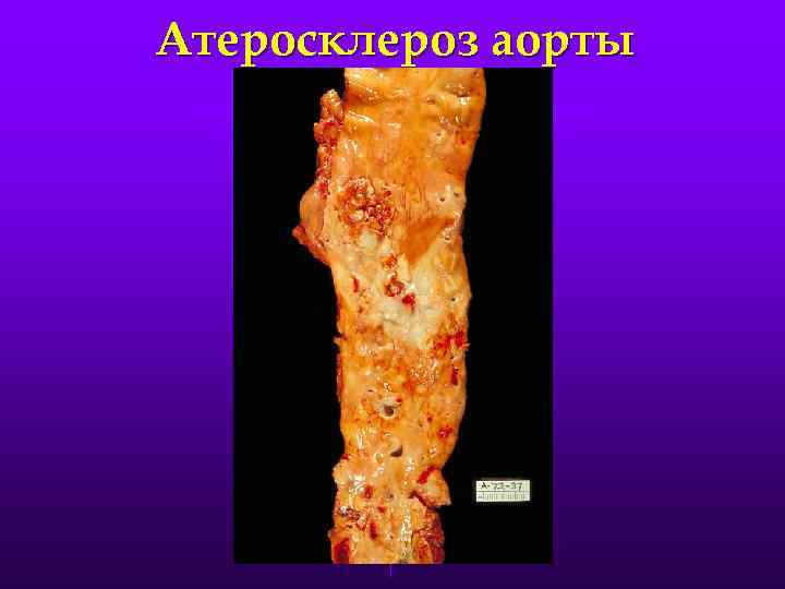 Атеросклероз аорты 
