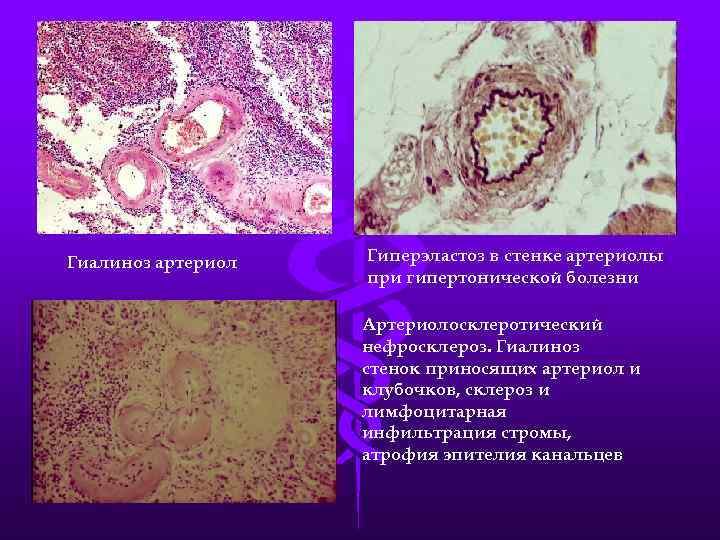 Гиалиноз артериол Гиперэластоз в стенке артериолы при гипертонической болезни Артериолосклеротический нефросклероз. Гиалиноз стенок приносящих