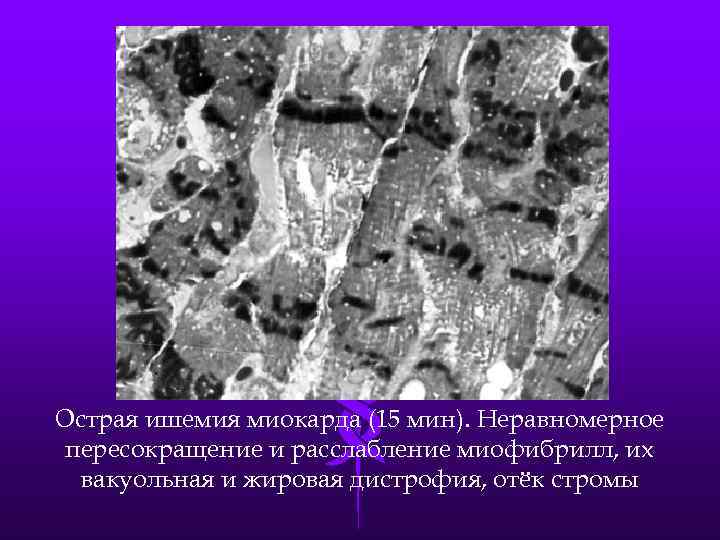 Острая ишемия миокарда (15 мин). Неравномерное пересокращение и расслабление миофибрилл, их вакуольная и жировая