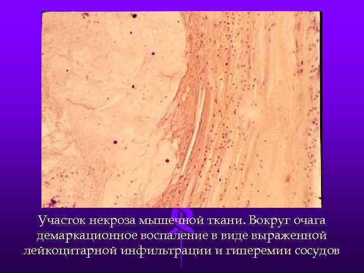 Участок некроза мышечной ткани. Вокруг очага демаркационное воспаление в виде выраженной лейкоцитарной инфильтрации и