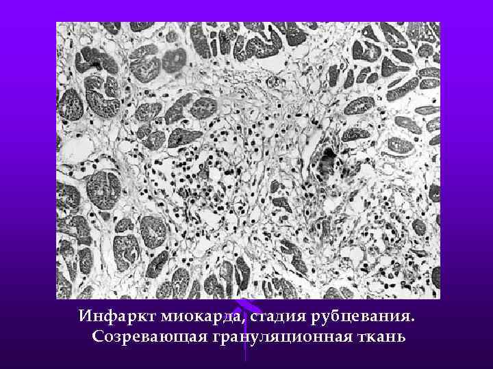 Инфаркт миокарда, стадия рубцевания. Созревающая грануляционная ткань 