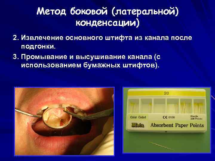 Метод боковой (латеральной) конденсации) 2. Извлечение основного штифта из канала после подгонки. 3. Промывание