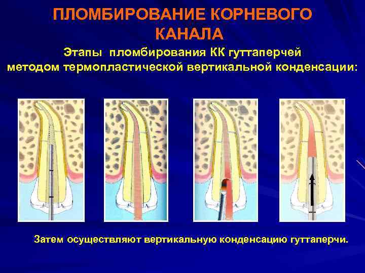 Методы пломбирование корневых каналов презентация