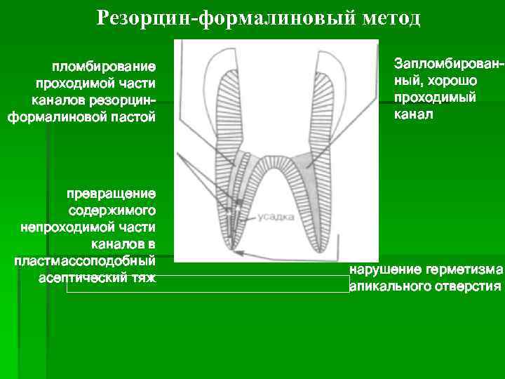 Резорцин-формалиновый метод пломбирование проходимой части каналов резорцинформалиновой пастой превращение содержимого непроходимой части каналов в