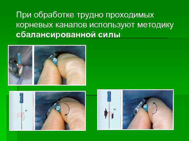 При обработке трудно проходимых корневых каналов используют методику сбалансированной силы 