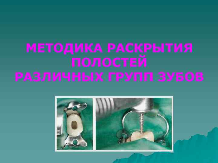 МЕТОДИКА РАСКРЫТИЯ ПОЛОСТЕЙ РАЗЛИЧНЫХ ГРУПП ЗУБОВ 
