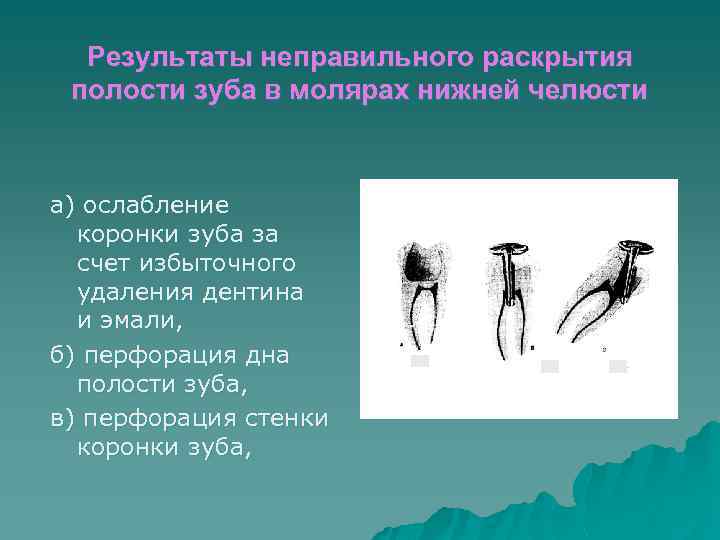 Результаты неправильного раскрытия полости зуба в молярах нижней челюсти а) ослабление коронки зуба за