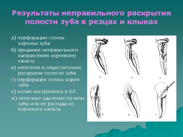 Результаты неправильного раскрытия полости зуба в резцах и клыках а) перфорации стенок коронки зуба