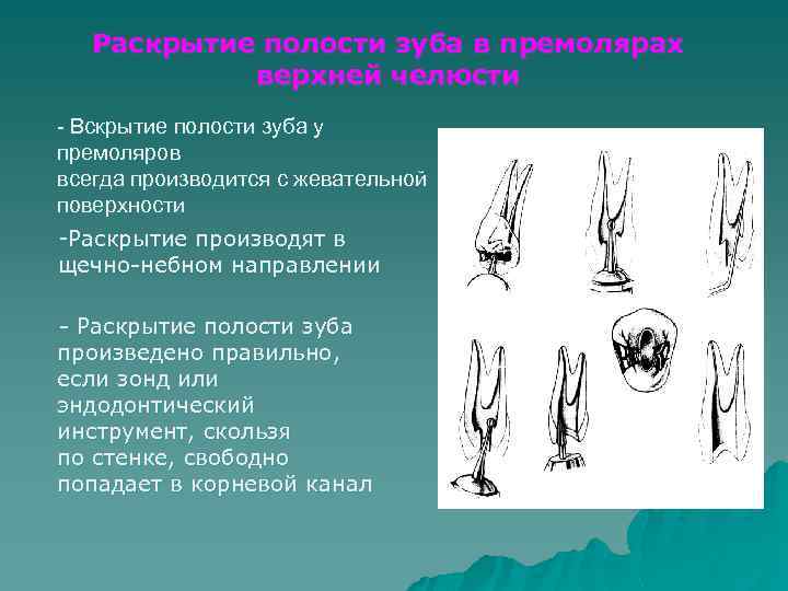 Раскрытие полости зуба в премолярах верхней челюсти - Вскрытие полости зуба у премоляров всегда