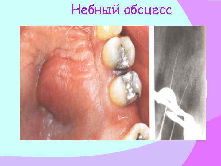 Небный абсцесс 