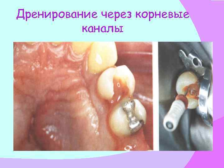 Дренирование через корневые каналы 