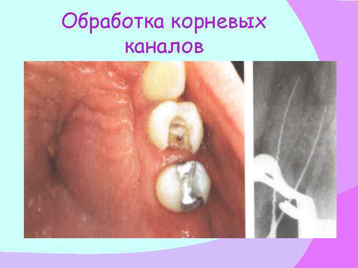 Обработка корневых каналов 