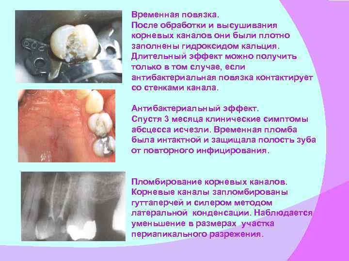 Временная повязка. После обработки и высушивания корневых каналов они были плотно заполнены гидроксидом кальция.