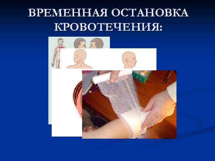 ВРЕМЕННАЯ ОСТАНОВКА КРОВОТЕЧЕНИЯ: 