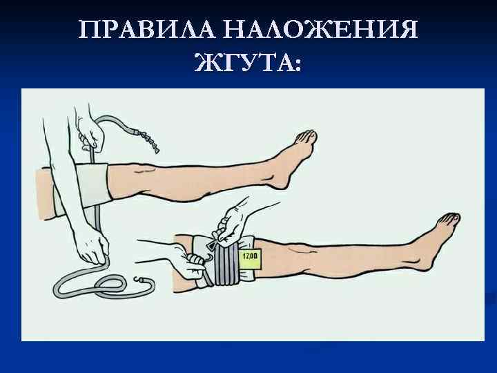 ПРАВИЛА НАЛОЖЕНИЯ ЖГУТА: 