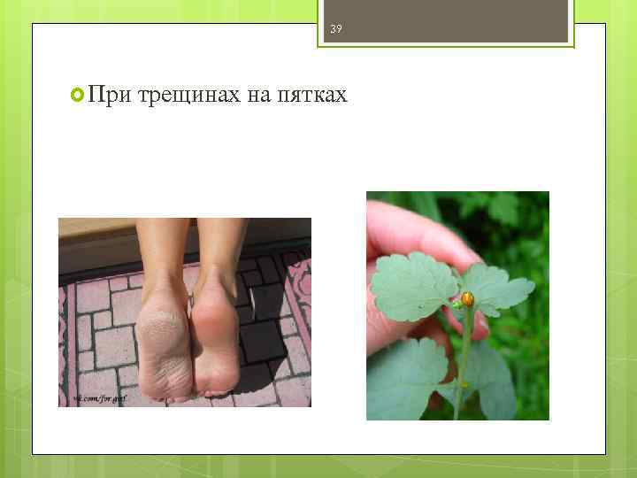 39 При трещинах на пятках 