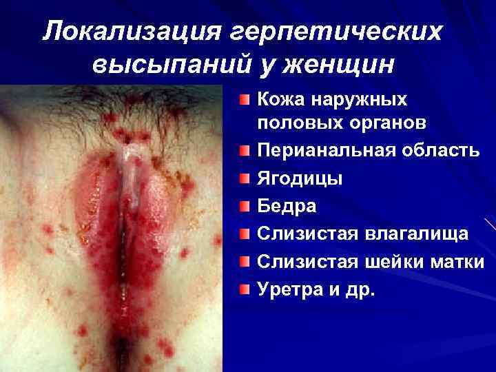 Локализация герпетических высыпаний у женщин Кожа наружных половых органов Перианальная область Ягодицы Бедра Слизистая