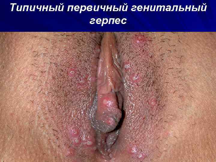 Типичный первичный генитальный герпес 