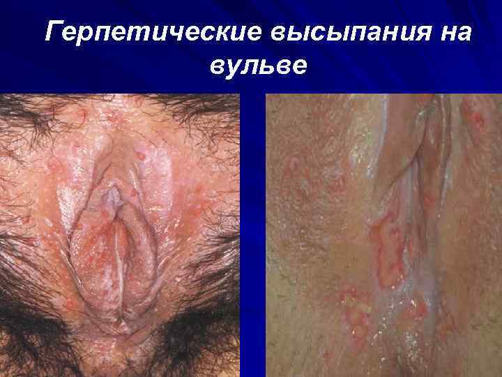 Герпетические высыпания на вульве 