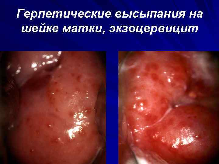 Герпетические высыпания на шейке матки, экзоцервицит 