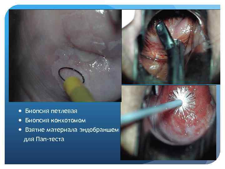  Биопсия петлевая Биопсия конхотомом Взятие материала эндобраншем для Пап-теста 