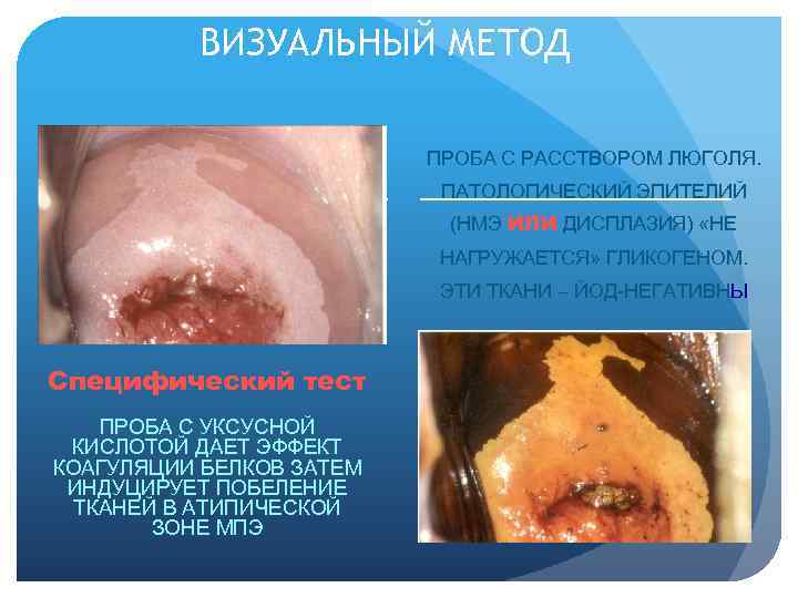  ВИЗУАЛЬНЫЙ МЕТОД ПРОБА С РАССТВОРОМ ЛЮГОЛЯ. ПАТОЛОГИЧЕСКИЙ ЭПИТЕЛИЙ (НМЭ ИЛИ ДИСПЛАЗИЯ) «НЕ НАГРУЖАЕТСЯ»