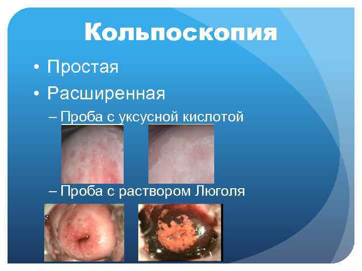  Кольпоскопия • Простая • Расширенная – Проба с уксусной кислотой – Проба с