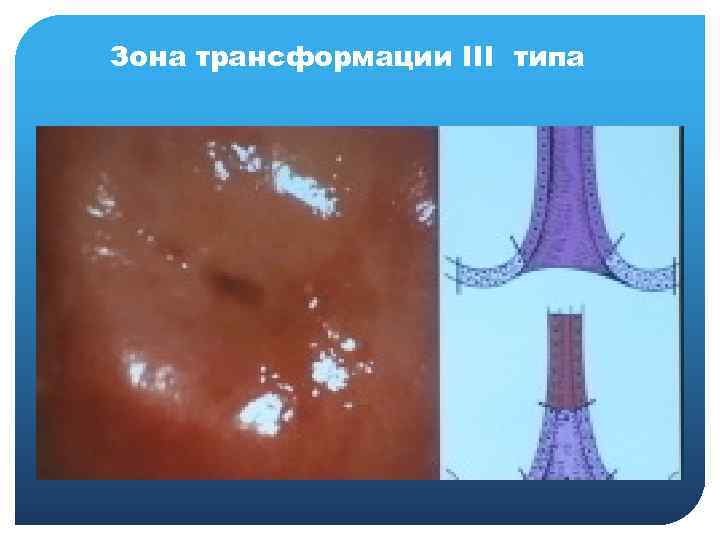 Зона трансформации III типа 