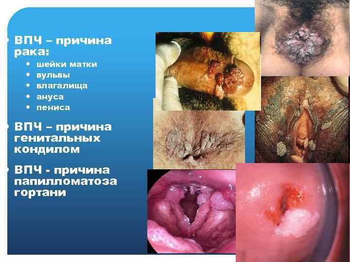  ВПЧ – причина рака: шейки матки вульвы влагалища ануса пениса ВПЧ – причина
