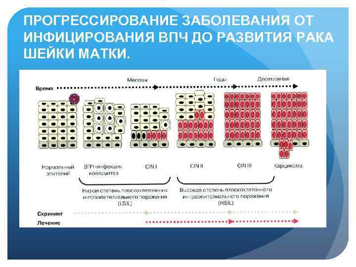 ПРОГРЕССИРОВАНИЕ ЗАБОЛЕВАНИЯ ОТ ИНФИЦИРОВАНИЯ ВПЧ ДО РАЗВИТИЯ РАКА ШЕЙКИ МАТКИ. 
