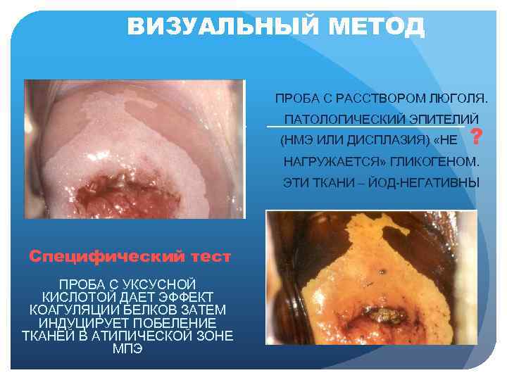 ВИЗУАЛЬНЫЙ МЕТОД ПРОБА С РАССТВОРОМ ЛЮГОЛЯ. ПАТОЛОГИЧЕСКИЙ ЭПИТЕЛИЙ (НМЭ ИЛИ ДИСПЛАЗИЯ) «НЕ ? НАГРУЖАЕТСЯ»