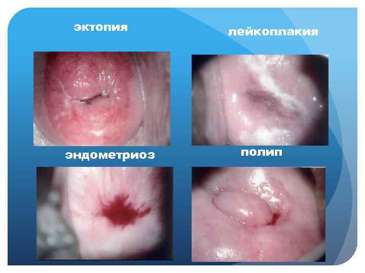эктопия эндометриоз лейкоплакия полип 