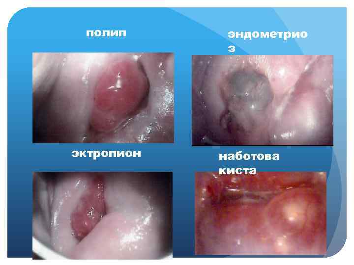 полип эктропион эндометрио з наботова киста 