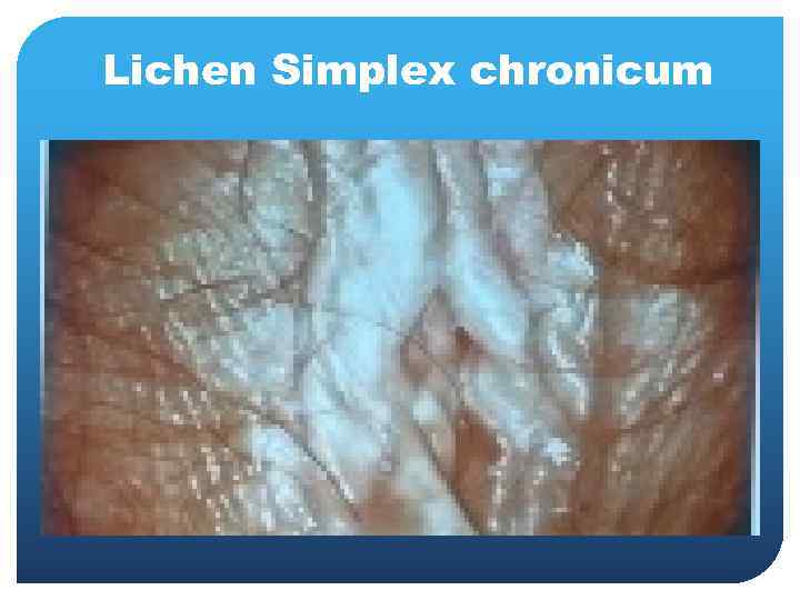 Lichen Simplex chronicum 