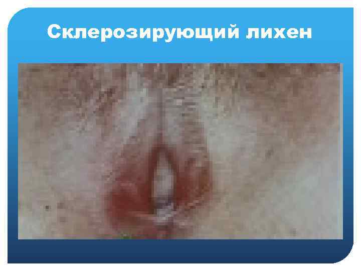 Cклерозирующий лихен 